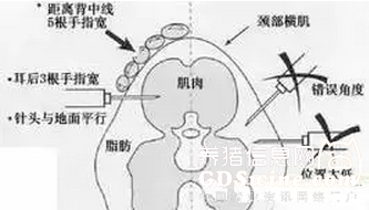 如何給豬針（圖解）：豬頸部豬舍部位模式圖